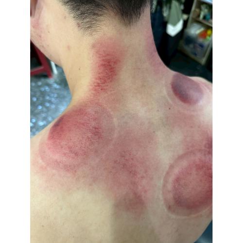 拔罐刮痧